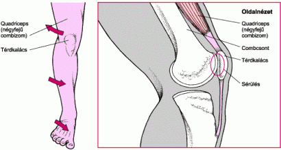 hogyan kerüljük el az ízületi sérüléseket futás közben megnyúlt térdszalag tünetei